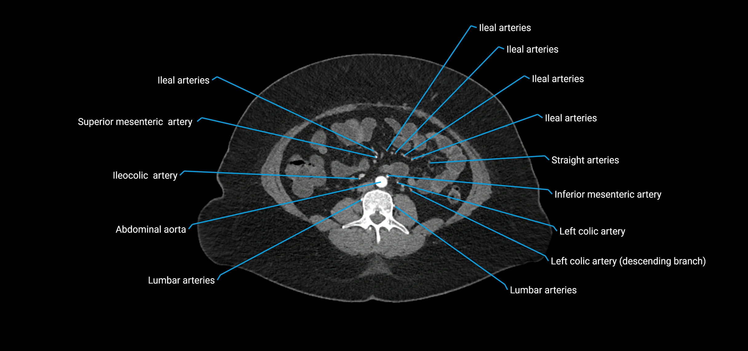 CTA abdomen axial cross sectional anatomy labelled image_116 (2).webp